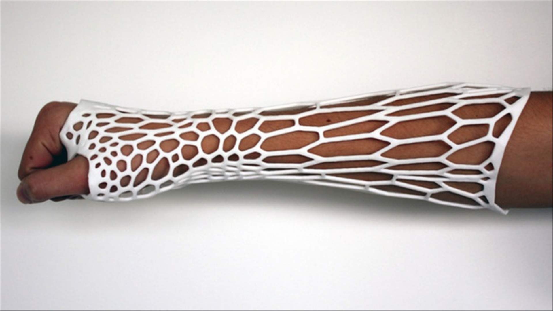 В 2013 году британский дизайнер Джейк Эвилл напечатал первый 3D-гипс, Cortex Exoskeletal.